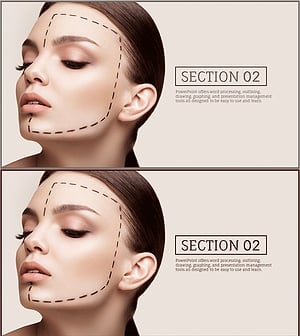 Stylish Slide for Plastic Surgery Pursuing Perfect Beauty